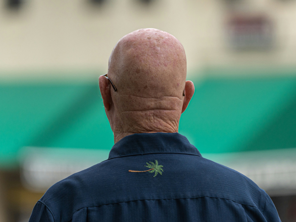 The Hidden Psychology of Hair Loss: Why Some Men Struggle More Than Others
